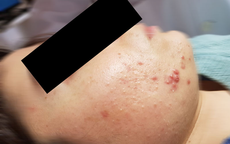 Acne - Dermatologo Dott.ssa Annunziata Pascarella