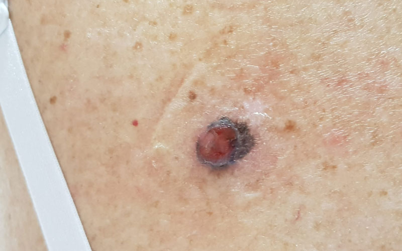 Tumori Cutanei - Dermatologo Dott.ssa Annunziata Pascarella