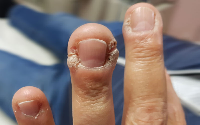 Verruche - Dermatologo Dott.ssa Annunziata Pascarella