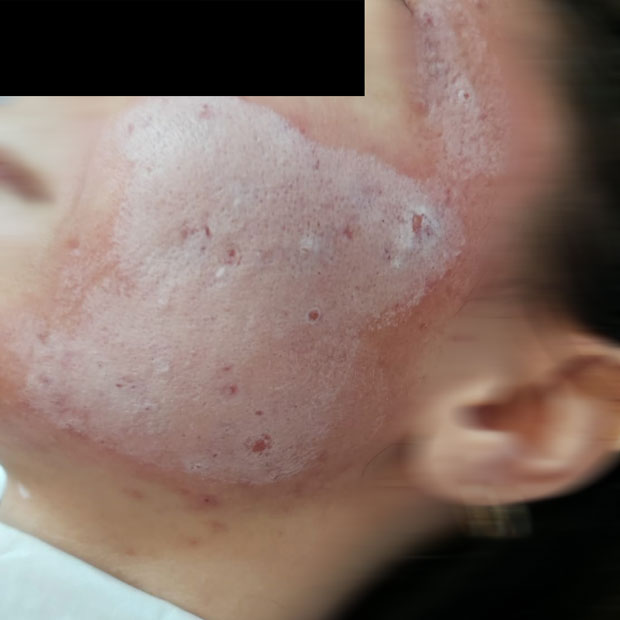 Peeling - Dermatologo Dott.ssa Annunziata Pascarella